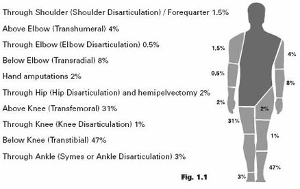 Epidemiology and Statistics of Amputation